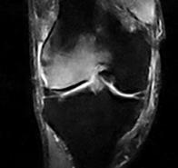 Edema Osseo / SONK è indicata in pazienti sintomatici con edema osseo acuto o cronico di origine idiopatica, post