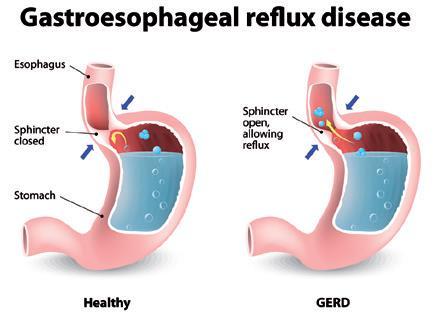 Reflusso gastroesofageo Il reflusso gastroesofageo consiste nella risalita di materiale gastrico acido proveniente dallo stomaco verso l esofago.