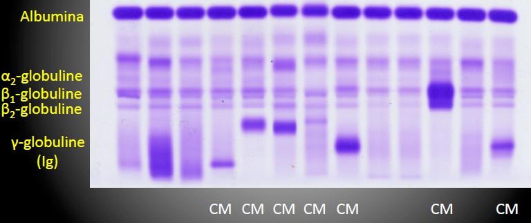 TRAGUARDI DIAGNOSTICI Il goal che ci dobbiamo dare è: trovare e quantificare la componente monoclonale prima che si manifesti rilevazione di varianti geniche delle proteine rilevazione di varianti