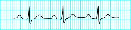 ECG Cosa sapere per non farsi prendere dal panico