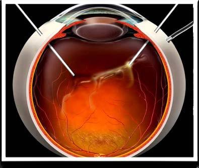 Terapia chirurgica e iniettiva Vitrectomia per