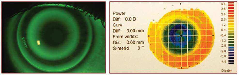 Epitelio 50 microns Strato di Bowmans 10 microns Stroma 465 microns Membrana di Descemet 10 microns Endotelio 5 microns Spesore