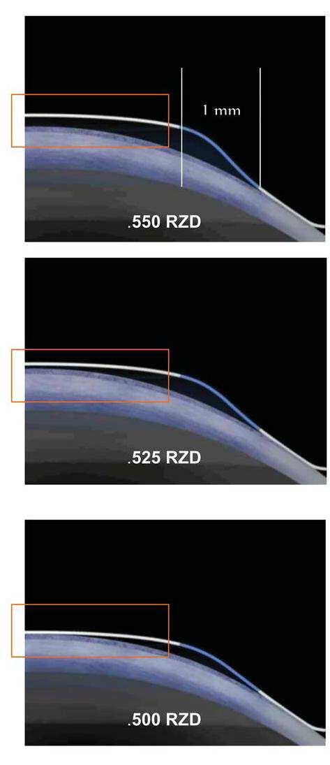 Zona di inversione La zona di inversione ha una larghezza di 1 mm e consiste in un segmento sigmoide lella lente che raccorda la geometria della lente nella zona centrale con la superficie corneale.