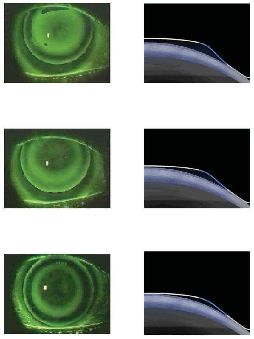 Una lente con profondità sagittale eccessiva (quindi con il valore di RZD troppo grande) avrà poco o nessun effetto sulla cornea.