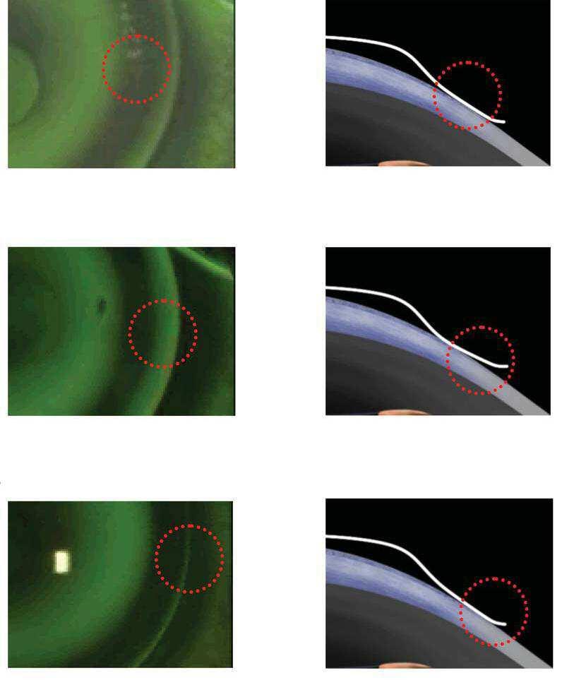 Il corretto valore di LZA è quello che garantisce il contatto tra lente e cornea nella zona centrale della zona di appoggio. Le lenti sono disponibili con diversi valori di LZA.