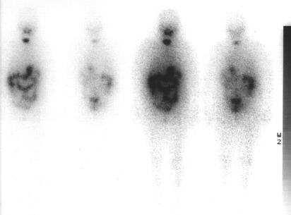 Rh-TSH vs sospensione L-tiroxina Accuratezza sostanzialmente comparabile (Mallick et al. 2012, Schlumberger et al.