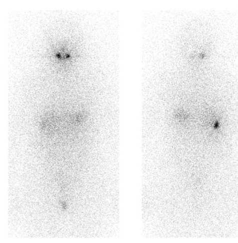 Iodio131 con M+ ossea ant post