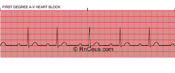 Criteri diagnostici del BAV I Ci devono essere le onde P Ci devono essere i QRS Le onde P e i QRS devono avere morfologia e asse