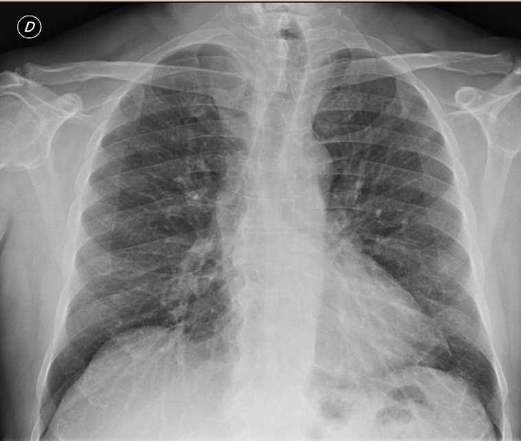 dislocazione e/o compressione trachea/esofago, calcificazioni SCINTIGRAFIA (I 131, Tc 99, TcMIBI 99m) Studio attività tiroidea in mediastino SPECT-CT I 131 - caratterizzazione di carcinoma