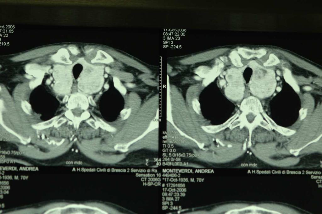 , massa inaccessibile da cervicotomia) INDICAZIONI STERNOTOMIA GM primario