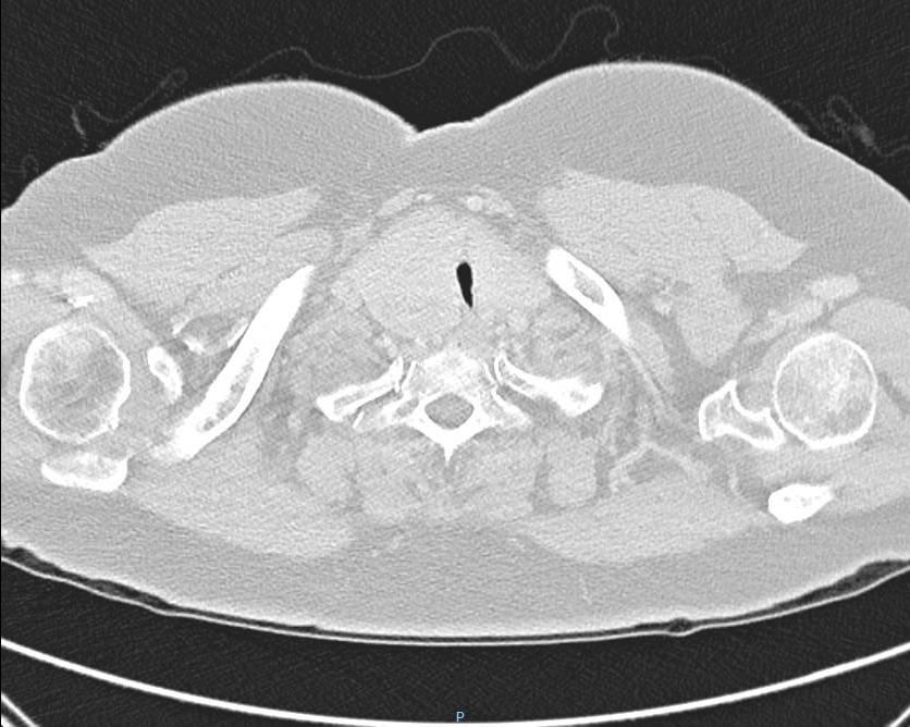 INDICAZIONI STERNOTOMIA Diagnosi pre-op. di tumore maligno 3-21% (localmente invasivo, dissezione LFN mediastinici) Gravi sintomi compressivi (Sdr. Cavale, ostruz.