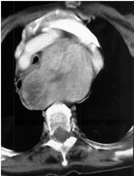 75 pazienti Tiroidectomia per GM CHIRURGIA GOZZO CERVICALE CHIRURGIA GOZZO MEDIASTINICO Dimensioni ghiandola > inlet toracico Ampia dissezione