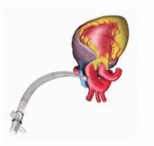 Figura 5. L aumento della dimensione del bulbo (da sinistra a destra) porta ad un importante variazione della struttura del flusso, come dimostrato dal campo vettoriale della velocità.