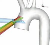 , 2014) che dimostra come sia possibile combinare il modello geometrico dell arco aortico del paziente e il modello CAD degli strumenti chirurgici nello stesso ambiente di simulazione multi-fisica.