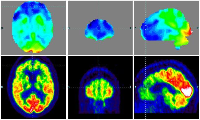 L indagine PET evidenziava un ipometabolismo corticale nelle regioni frontali, nel giro del cingolo anteriore e nelle regioni temporali confermando il sospetto clinico di FTD.