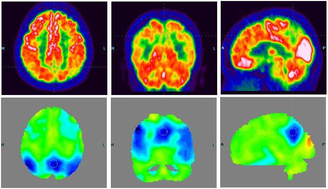 L indagine PET evidenziava un ipometabolismo corticale nelle regioni parietali posteriori, nel giro del cingolo posteriore, nel precuneo e nelle regioni temporali più evidente in sede laterale,