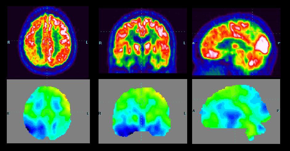 L indagine PET evidenziava un ipometabolismo corticale nelle regioni parietali posteriori, nel giro del cingolo posteriore e nel precuneo con netta prevalenza di lato dx, e nelle regioni temporali