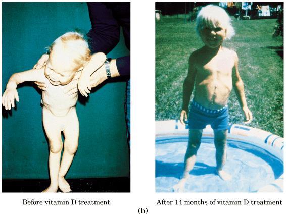 La somministrazione di Vitamina D ha effetto benefico sul rachitismo -> se non in