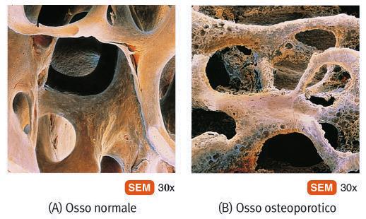 MENOPAUSA -> forte calo degli ormoni sessuali L OSTEOPOROSI è una patologia multifattoriale, causata da una patologica riduzione della massa ossea (componente