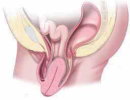 PROLASSO UTERINO Per prolasso uterino si intende la discesa dell utero, dalla sua normale sede nella piccola pelvi, verso il basso, all interno del canale vaginale, fino a fuoriuscire dal vestibolo