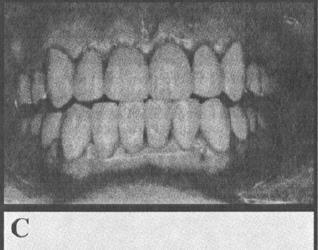 È stato creata un'adeguata guida propriocettiva anteriore con corone di lunghezza appropriata, che ha ripristinato l'attività muscolare armonica per una funzione normale e al tempo