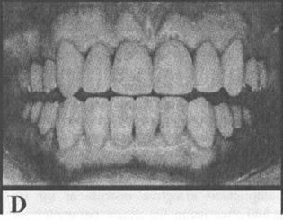 Il paziente ha mantenuto i contatti di posizione centrica con i denti anteriori per più di cinque anni, e non ha avuto recidiva della disfunzione temporomandibolare e del dolore