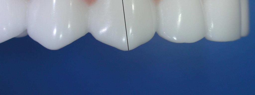 Nell arcata inferiore, utilizzando la carta di posizionamento, i bracket sono posizionati sul centro della corona clinica tranne che a livello di canino e primo molare dove lo slot è 0.