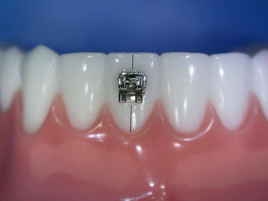 Quando il dente presenta un anatomia normale e utilizziamo bracket di forma romboidale possiamo allineare le componenti orizzontali del bracket con i margini incisali.