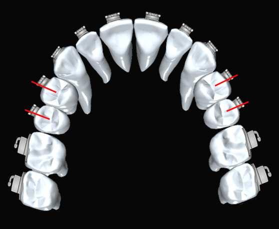 IIª CLASSE Nei casi che presentano rapporti dentali di IIª classe è utile posizionare i bracket dei premolari superiori 0.