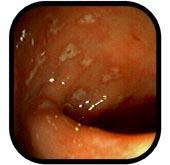 Sindrome di Zöllinger-Ellison -Gastrinoma = Ipergastrinemia =