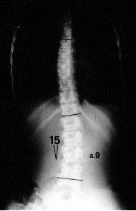 ..ma la scoliosi parte da lontano La patologia è progressiva e difficilmente si può prevedere l