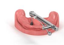 2. Creazione di una nuova overdenture con il sistema di ritenzione Novaloc 2.