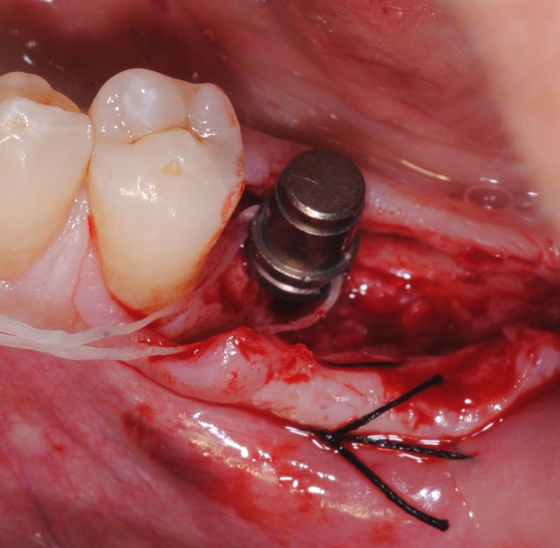 digitale fin dall'inizio Concetti di base sulle diverse tipologie implantari; macrodesign, microdesign Preparazione del campo operatorio (Sessione Parallela