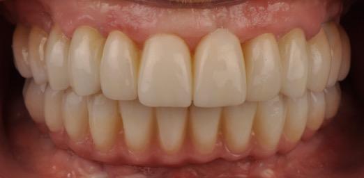 Programma Terzo Modulo Gestione del Paziente edentulo 18-19 Maggio 2018 Gestione del paziente edentulo o con denti non conservabili