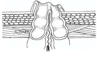Stomia laterale E una stomia con due aperture: la prima evacua feci, la seconda muco. Può essere confezionata nel piccolo e nel grande intestino, solitamente nel colon trasverso.