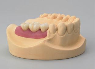 Procedura protesica 6.4.2 Componente Secondaria in Oro per ponte Procedura di protesica La ricostruzione definitiva è consegnata allo studio odontoiatrico sul modello master.