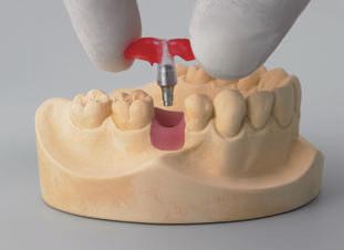 Procedura protesica Procedura protesica La ricostruzione definitiva è consegnata allo studio odontoiatrico sul modello master.