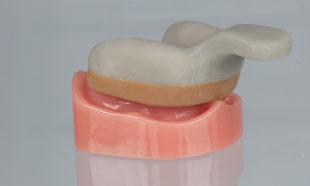 Procedura protesica Per i restauri di dente singolo, utilizzare le componenti per presa d impronta con accoppiamento; per i restauri di più denti utilizzare quelli senza accoppiamento.