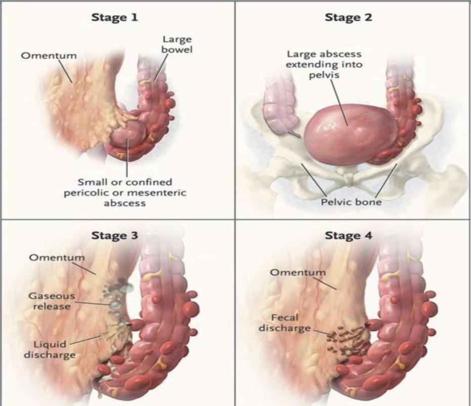 Diverticolite Staging chirurgico Stadio 1: ascesso pericolico Stedio 2: ascesso incapsulato, confinato all addome inferiore, al retroperitoneo o