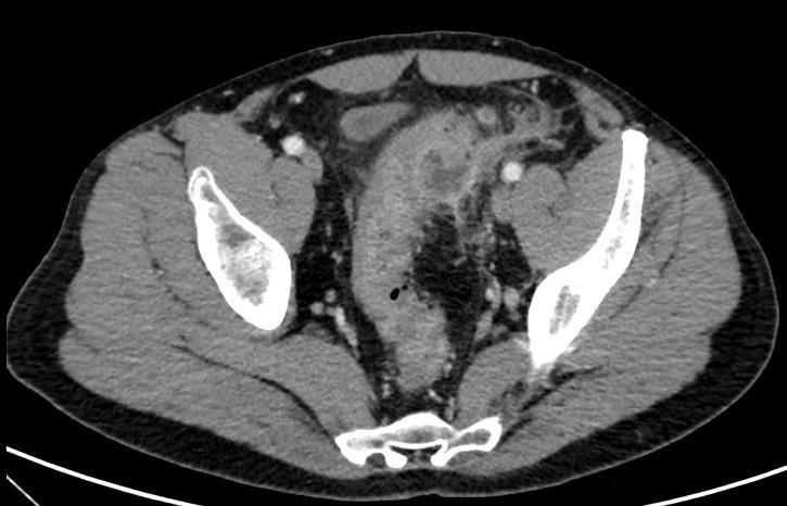 Lunghezza del segmento di colon interessato Segni TC predittivi