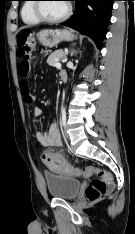 interessato Severità della diverticolite acuta Van Dijk S.T.