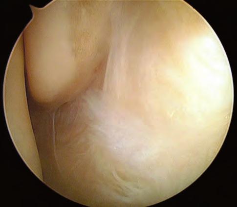 (b) Tendine del FLA, limite mediale del fascio vascolo-nervoso posteriore, trattenuto da un palpatore, sulla sinistra.