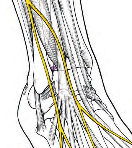 (c) Schema anatomico che mostra la sede del portale AL, 5 mm al di sopra della linea articolare,