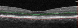 retinica NUOVA TECNOLOGIA Plesso
