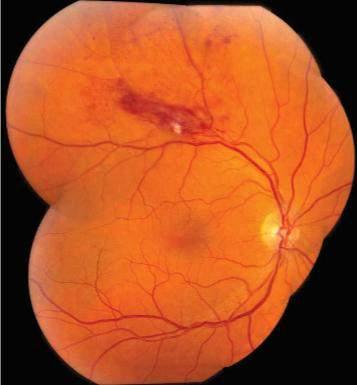 OCT-A e RVO Le occlusioni venose retiniche (RVO) sono una delle principali cause di perdita della vista e