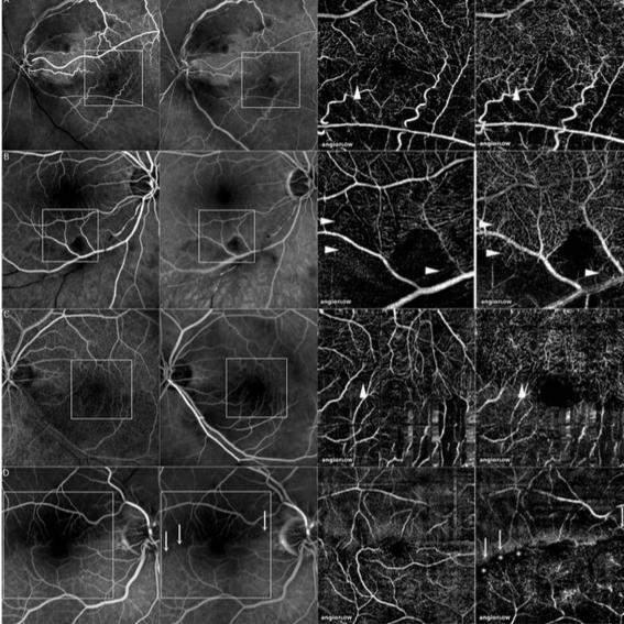 L' OCT-A può distinguere con precisione i plessi capillari retinici a diversi livelli negli