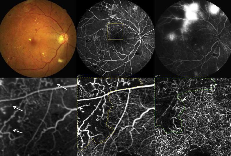 La superficie media di retina non perfusa nel plesso superficiale