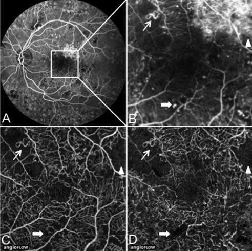 20 occhi con differenti stadi di RD Nel plesso vascolare superficiale, la RD determina rarefazione capillare con aree di non perfusione capillare al di fuori della FAZ in tutti gli occhi.