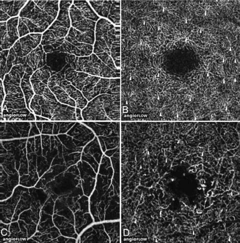 Nel plesso vascolare profondo (DCP), aree di non perfusione capillare al di fuori della FAZ sono state osservate solo in 7 dei 20 occhi (35%).