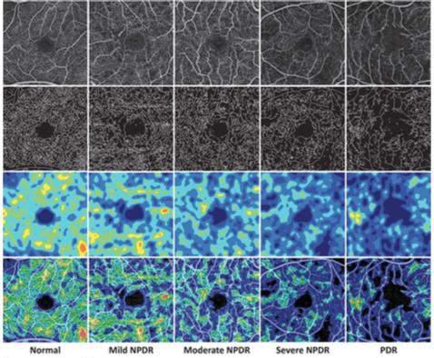 Vessel Density )dei capillari retinici che